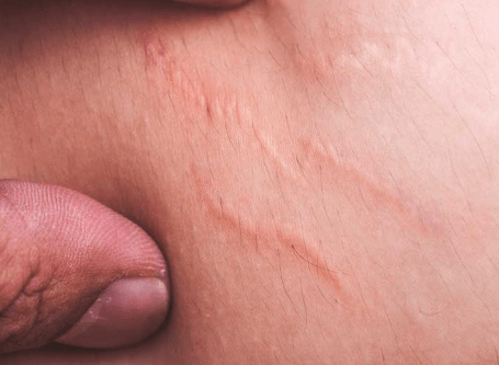 Stretch Marks on Thighs on Teenager Causes and Remedies