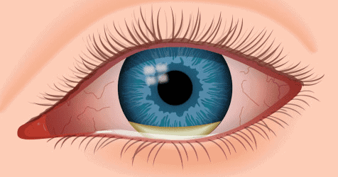 common eye infections