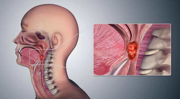 Throat cancer symptoms