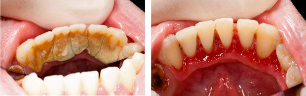 dental calculus before and after