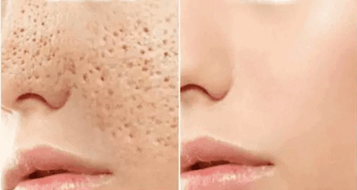 face pores treatment home in tamil