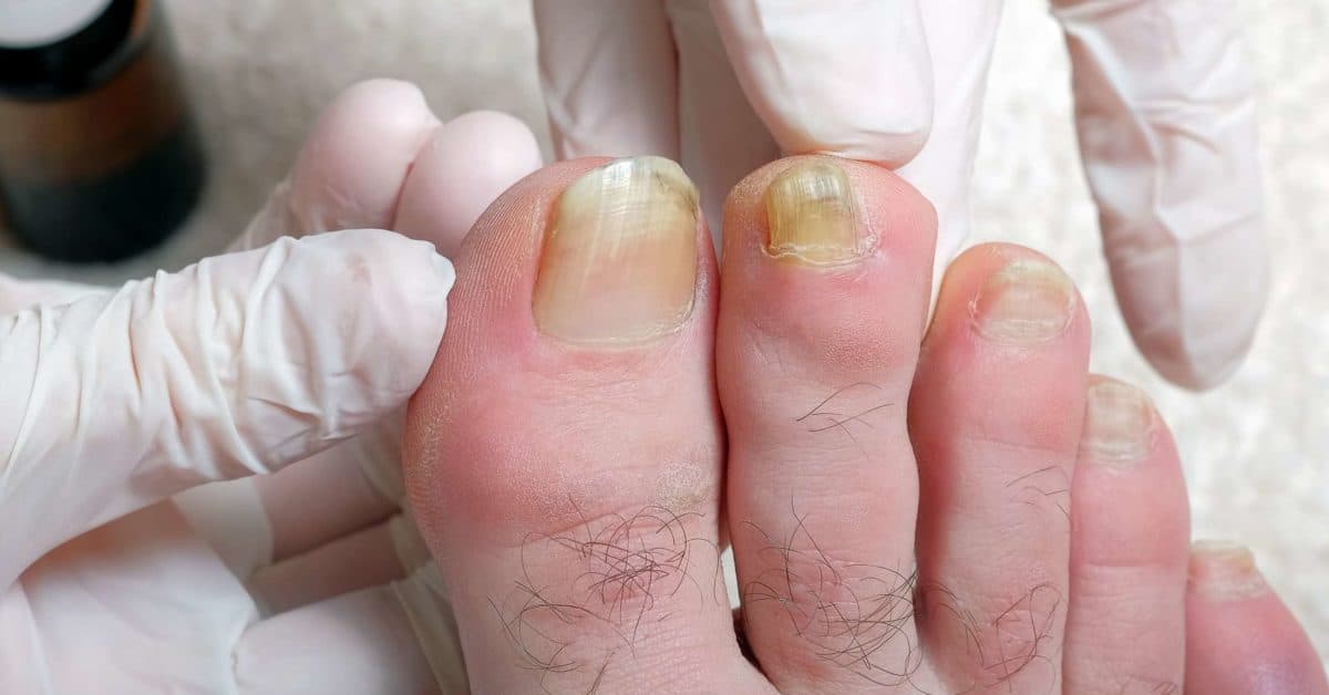 How To Get Rid Of Yellow Toenails Fast With Home Remedies - YeyeLife