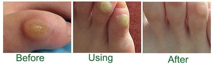 Home Remedies For Corns On Feet: It Causes and Symptoms - YeyeLife