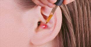 how to get rid of a pimple in your ear