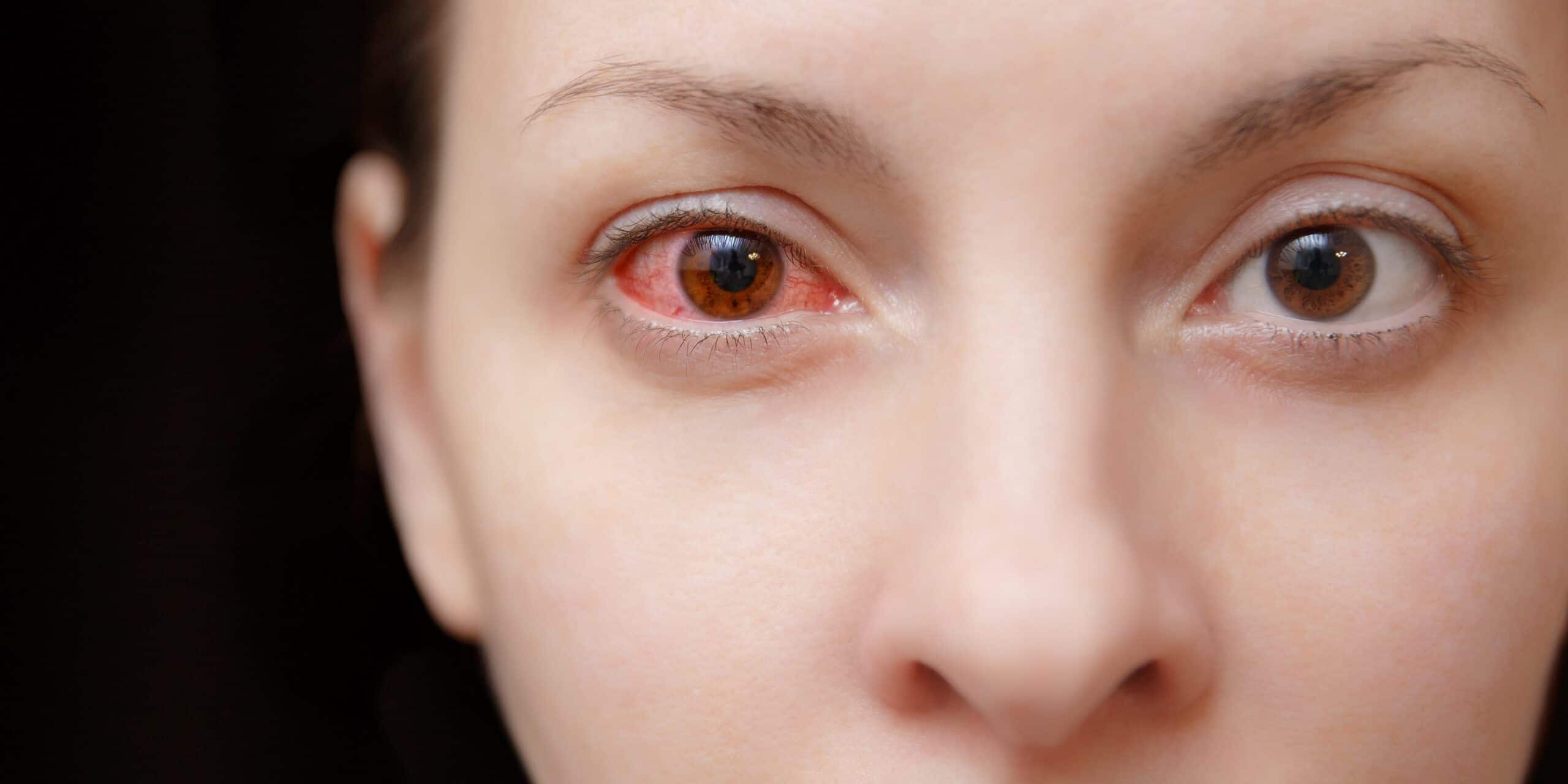Natural Treatment For Pink Eye (conjunctivitis) YeyeLife