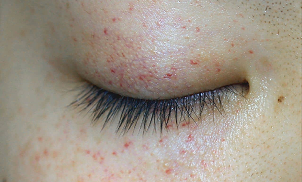 red-rash-around-eyes-causes-symptoms-and-remedies-yeyelife