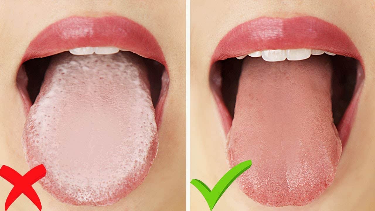 Natural Treatment To Get Rid Of White Tongue - YeyeLife