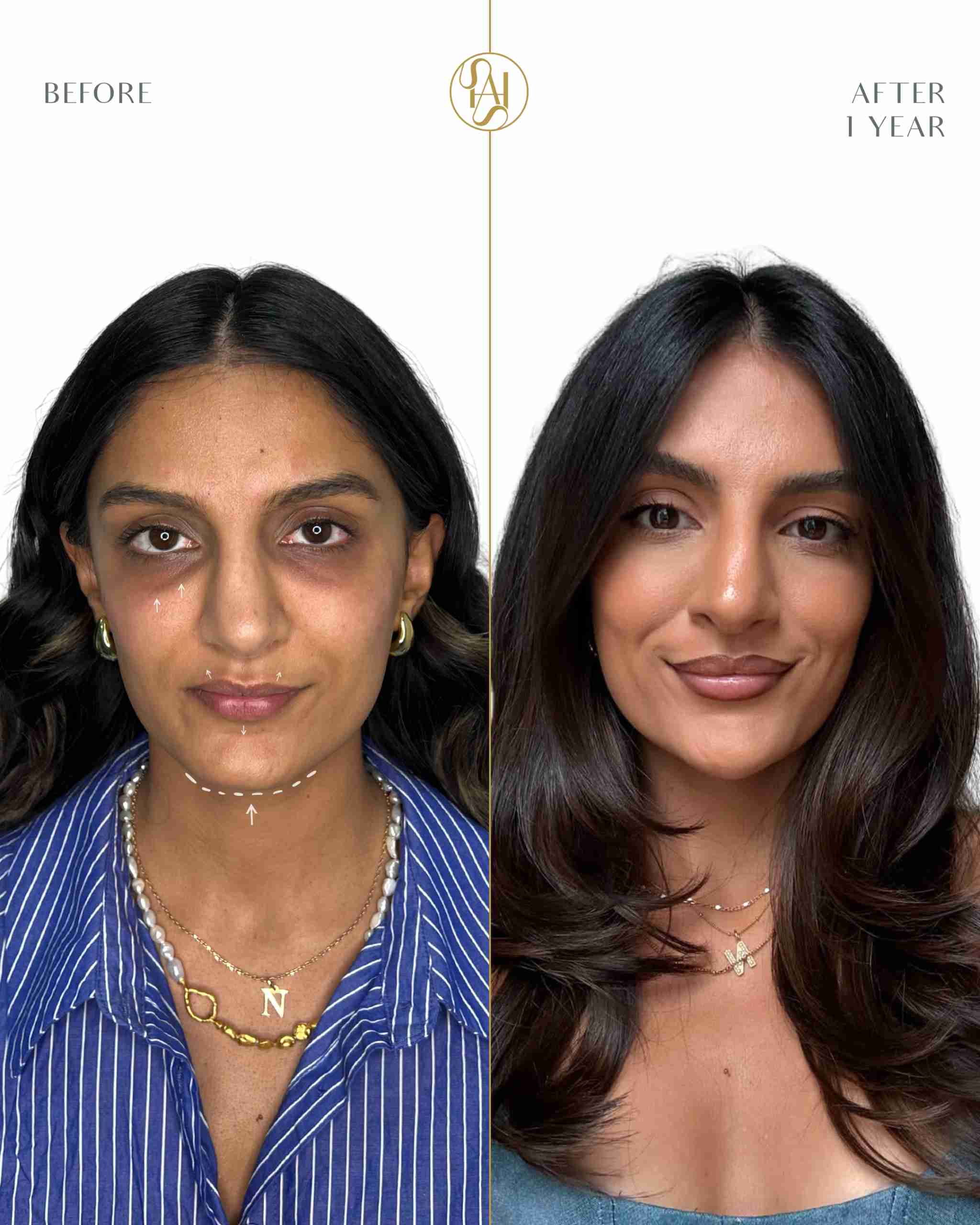 Full face rejuvenation result 2